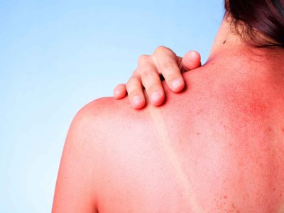 Piel y verano: señales, cambios y síntomas que no deben pasarse por alto
