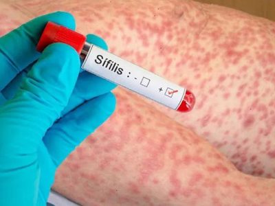 Preocupa en Neuquén el crecimiento de los casos de sífilis en la provincia y en el país