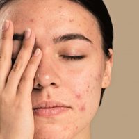 Con 1 ingrediente que siempre tenés en la cocina: la terapia viral para quitar acné y manchas de la piel
