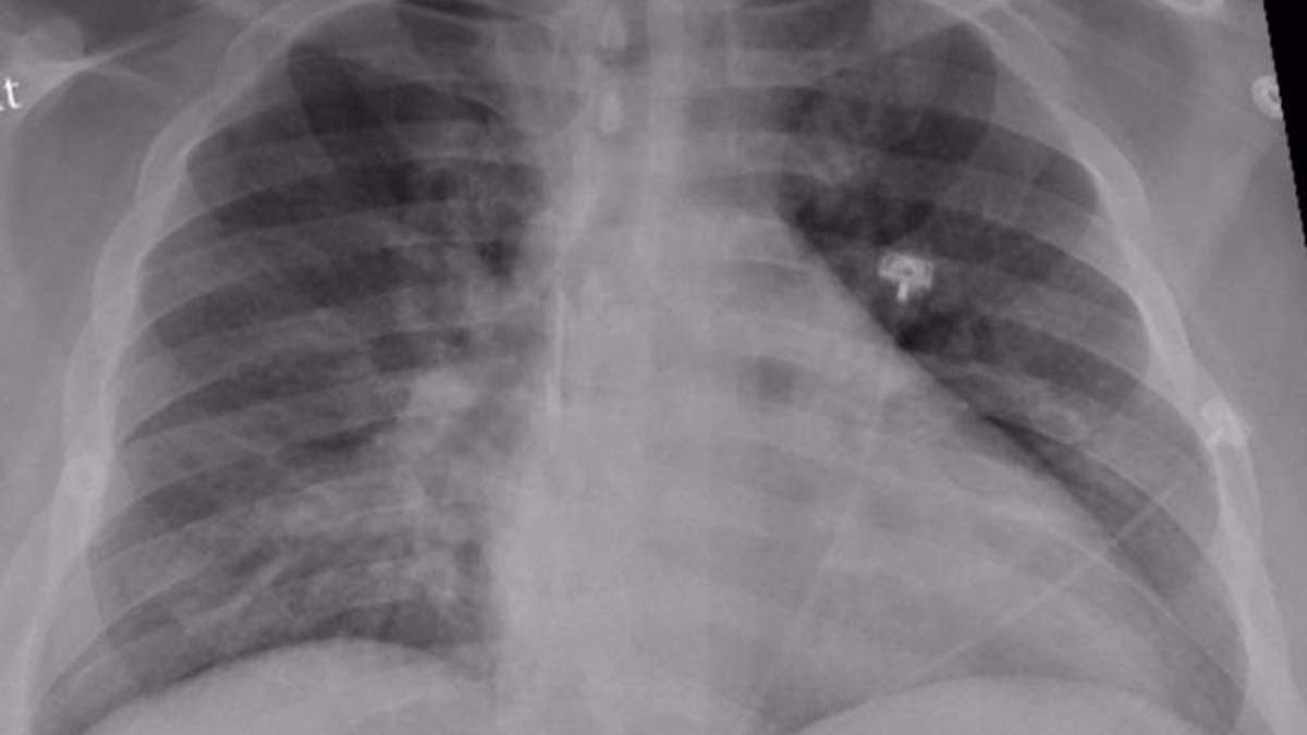 Radiografía que muestra neumonía