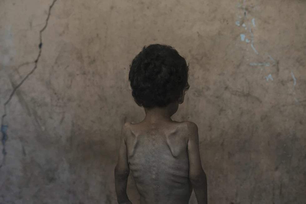 Yazan Abu Ful, un niño desnutrido de 2 años, posa para una foto en la casa de su familia en el campo de refugiados de Shati, en la ciudad de Gaza, el miércoles 23 de julio de 2025.
