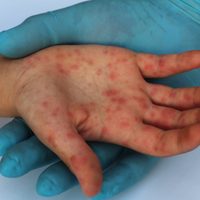 Brote de sarampión en México en medio de la crisis por la pandemia del coronavirus