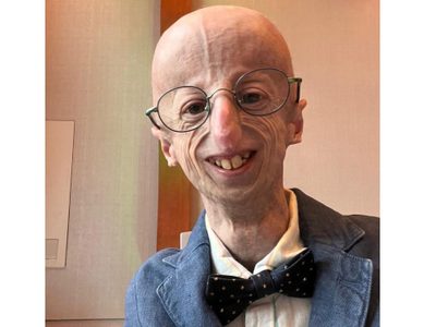 Murió Sammy Basso a los 28 años; padecía síndrome que acelera el envejecimiento