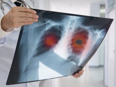 Cáncer de pulmón debe ser contrarrestado con tamizaje y revisión médica obligatoria: Oncólogos