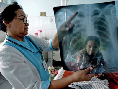 La OMS alertó sobre otra crisis sanitaria: la pandemia hizo subir las muertes por tuberculosis