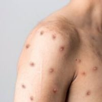 OMS subraya que el mpox sigue siendo una emergencia de salud pública de preocupación internacional