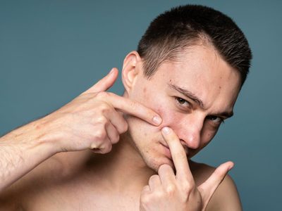 Levadura, un aliado natural contra el acné