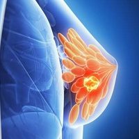 Descubren un factor que explica la propagación de metástasis a los huesos en el cáncer de mama