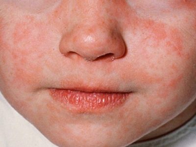 Detectan caso importado de sarampión en el AICM; es un niño originario de Rumanía