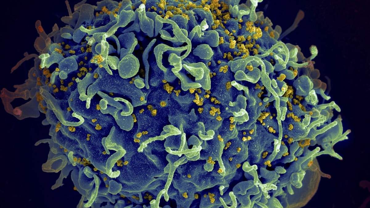 ARCHIVO - Esta imagen de un microscopio electrónico proporcionada por los Institutos Nacionales de Salud de Estados Unidos muestra una célula humana T, en azul, atacada por virus del VIH, el virus que causa el sida, en amarillo