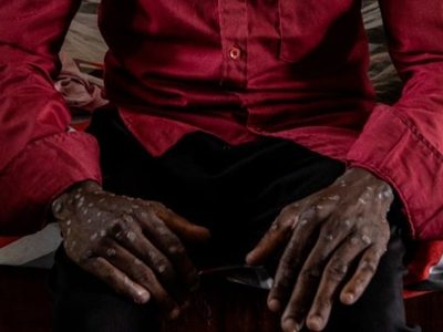 Detectan viruela del mono en un joven de 26 años de edad en Huatulco, Oaxaca