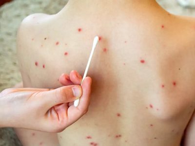 Por el aumento de casos de sarampión, el Ministerio de Salud vacunará con la doble viral en el AMBA
