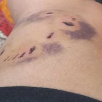 Ataque de perros en Villa La Angostura: una mujer fue mordida y teme por la salud de su bebé