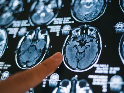 ¿Qué es un hematoma subdural, la dolencia que padece Ginés González García?