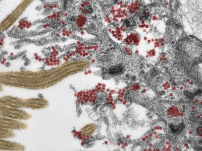 Médicos alemanes descubren cómo el coronavirus entra al cerebro