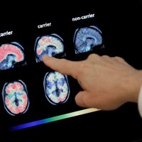 Vivir más tiempo podría aumentar el riesgo de demencia, pero hay formas de reducirlo