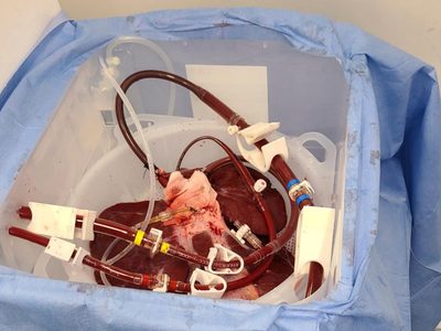 Probarán si hígado de cerdo puede usarse para tratamiento similar a diálisis