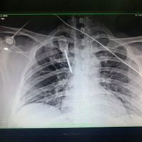 Clavan desarmador en el pecho a un médico de Monterrey durante asalto