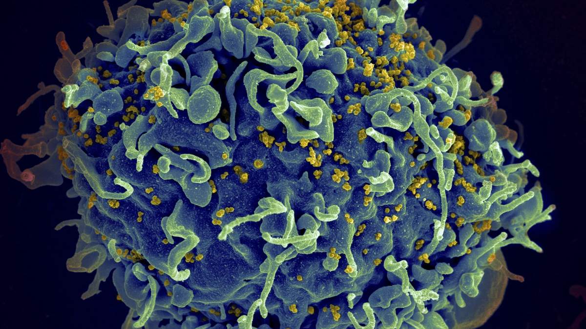 Célula T humana, en azul, siendo atacada por VIH, en amarillo