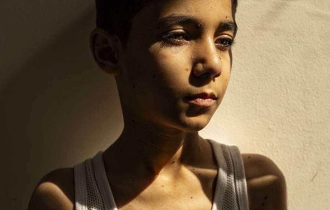 Niño Mahmoud Ajjour, de 9 años, sin brazos justo debajo de cada hombro